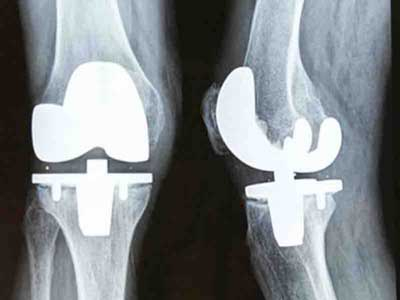 Knee Replacement Surgery In UAE